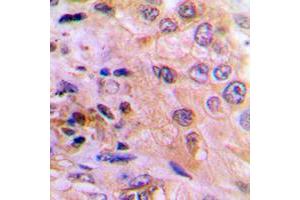 Immunohistochemical analysis of DUSP6 staining in human lung cancer formalin fixed paraffin embedded tissue section. (DUSP6 antibody  (Center))