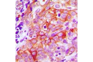 Immunohistochemical analysis of Beta-2 Adrenergic Receptor staining in human prostate cancer formalin fixed paraffin embedded tissue section. (beta 2 Adrenergic Receptor antibody  (C-Term))