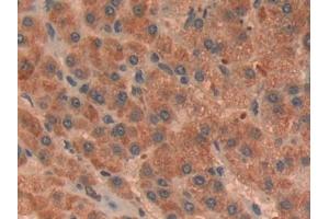Detection of RORg in Human Liver cancer Tissue using Polyclonal Antibody to RAR Related Orphan Receptor Gamma (RORg) (RORC antibody  (AA 212-461))