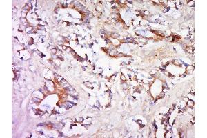 Paraformaldehyde-fixed, paraffin embedded human cervical cancer, Antigen retrieval by boiling in sodium citrate buffer (pH6) for 15min, Block endogenous peroxidase by 3% hydrogen peroxide for 30 minutes, Blocking buffer (normal goat serum) at 37°C for 20min, Antibody incubation with Rabbit Anti-SIPA1L2 Polyclonal Antibody, Unconjugated  at 1:500 overnight at 4°C, followed by a conjugated secondary for 90 minutes and DAB staining. (SIPA1L2 antibody  (AA 251-350))