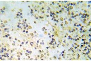 Immunohistochemistry (IHC) analyzes of p-ER-a (pSer118) pAb in paraffin-embedded human breast carcinoma tissue. (Estrogen Receptor alpha antibody  (pSer118))
