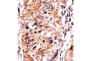 Formalin-fixed and paraffin-embedded human cancer tissue reacted with the primary antibody, which was peroxidase-conjugated to the secondary antibody, followed by DAB staining. (CDKN2A antibody  (pSer140))