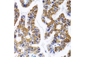 Immunohistochemistry of paraffin-embedded human gastric cancer using FASN antibody. (Fatty Acid Synthase antibody)
