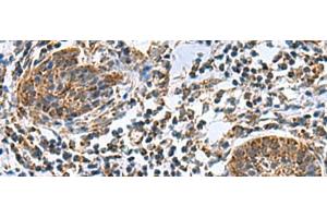 Immunohistochemistry of paraffin-embedded Human esophagus cancer tissue using MRPL40 Polyclonal Antibody at dilution of 1:80(x200) (MRPL40 antibody)