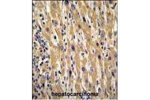 GAL Antibody (Center) (ABIN655055 and ABIN2844684) immunohistochemistry analysis in formalin fixed and paraffin embedded human hepatocarcinoma followed by peroxidase conjugation of the secondary antibody and DAB staining. (GAL antibody  (AA 48-79))