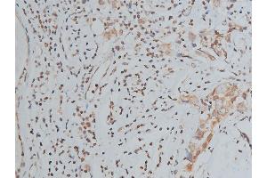 ABIN6267039 at 1/200 staining human breast cancer tissue sections by IHC-P. (Histone 3 antibody)