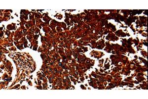 Immunohistochemistry of paraffin-embedded Human lung cancer tissue using ANXA7 Polyclonal Antibody at dilution 1:40 (Annexin VII antibody)
