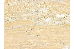 ABIN6260791 and ABIN6273208 at 1/100 staining human tongue carcinoma by IHC-P.