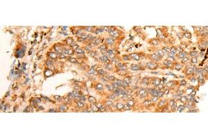 Immunohistochemistry of paraffin-embedded Human liver cancer tissue using BPGM Polyclonal Antibody at dilution of 1:70(x200)