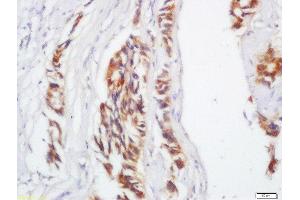 Formalin-fixed and paraffin embedded human colon carcinoma labeled with Anti-IL-17C Polyclonal Antibody, Unconjugated  at 1:200 followed by conjugation to the secondary antibody and DAB staining. (IL17C antibody  (AA 101-197))