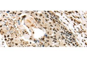 Immunohistochemistry of paraffin-embedded Human esophagus cancer using TALDO1 Polyclonal Antibody at dilution of 1/30 (TALDO1 antibody)