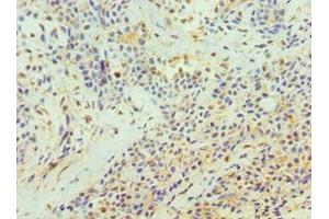 Immunohistochemistry of paraffin-embedded human breast cancer using ABIN7172210 at dilution of 1:100 (TFPI2 antibody  (AA 23-235))