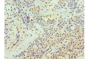 Immunohistochemistry of paraffin-embedded human breast cancer using ABIN7172210 at dilution of 1:100