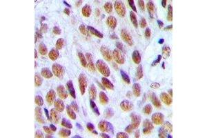 Immunohistochemical analysis of p300 staining in human breast cancer formalin fixed paraffin embedded tissue section. (p300 antibody  (N-Term))