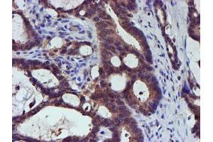 Immunohistochemical staining of paraffin-embedded Adenocarcinoma of Human colon tissue using anti-SMS mouse monoclonal antibody.