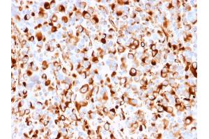 Formalin-fixed, paraffin-embedded human Melanoma stained with NGFR Mouse Recombinant Monoclonal Antibody (rNGFR/1965). (Recombinant NGFR antibody  (AA 281-421))
