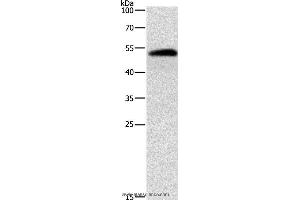 Western blot analysis of Human liver cancer tissue, using ALDH1B1 Polyclonal Antibody at dilution of 1:900 (ALDH1B1 antibody)