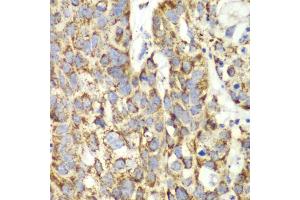 Immunohistochemistry of paraffin-embedded human lung cancer using UGDH antibody (ABIN6293152) at dilution of 1:100 (40x lens). (UGDH antibody)