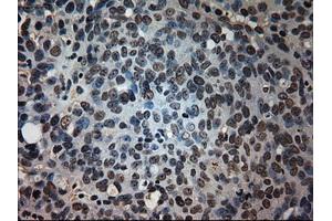 Immunohistochemical staining of paraffin-embedded Adenocarcinoma of colon tissue using anti-PROM2mouse monoclonal antibody. (Prominin 2 antibody)