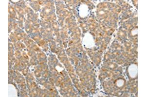 The image on the left is immunohistochemistry of paraffin-embedded Human thyroid cancer tissue using (TEP1 Antibody) at dilution 1/50, on the right is treated with synthetic peptide.