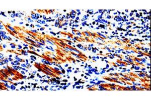 Immunohistochemistry of paraffin-embedded Human stomach cancer tissue using ACSBG2 Polyclonal Antibody at dilution 1:60