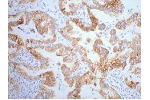 IHC staining of human lung cancer tissue, diluted at 1:200. (Cytokeratin 7 antibody)