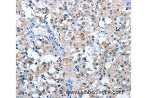 Immunohistochemistry of Human thyroid cancer using ASB2 Polyclonal Antibody at dilution of 1:50 (ASB2 antibody)