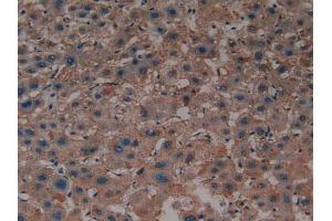 IHC-P analysis of Human Liver Cancer Tissue, with DAB staining. (Sonic Hedgehog antibody  (AA 36-193))