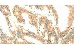 Immunohistochemistry of paraffin-embedded Human colon cancer tissue using P23 Polyclonal Antibody at dilution 1:50 (CDK5R1 antibody)