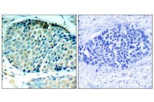 Immunohistochemical analysis of paraffin-embedded human breast carcinoma tissue, using HSP27 (phospho- Ser78) antibody (E011247). (HSP27 antibody  (pSer78))