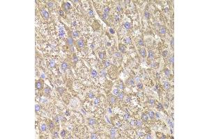 Immunohistochemistry of paraffin-embedded human liver injury using CIAPIN1 Antibody. (CIAPIN1 antibody  (AA 1-312))