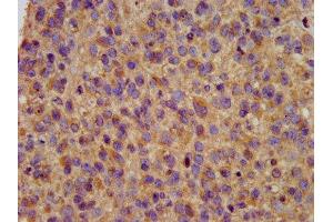 IHC image of ABIN7163983 diluted at 1:200 and staining in paraffin-embedded human glioma performed on a Leica BondTM system. (Kcne3 antibody  (AA 1-57))