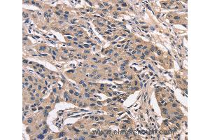 Immunohistochemistry of Human lung cancer using PEBP1 Polyclonal Antibody at dilution of 1:40