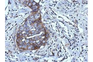 AP31123PU-N RGS4 antibody staining of Paraffin-Embedded Breast Carcinoma at 1/500 dilution. (RGS4 antibody  (AA 1-188))