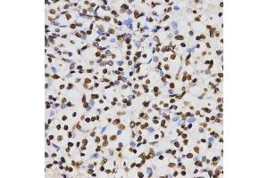 Immunohistochemistry of paraffin-embedded human kidney cancer using Dimethyl-Histone H3-K4 antibody (ABIN5969803) at dilution of 1/200 (40x lens). (Histone 3 antibody  (H3K4me2))