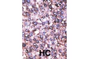 Formalin-fixed and paraffin-embedded human cancer tissue reacted with the primary antibody, which was peroxidase-conjugated to the secondary antibody, followed by AEC staining. (MAGED2 antibody  (C-Term))