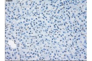 Immunohistochemical staining of paraffin-embedded Adenocarcinoma of ovary tissue using anti-SORDmouse monoclonal antibody. (SORD antibody)