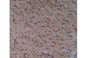 Detection of PAK1 in Human Glioma Tissue using Polyclonal Antibody to p21 Protein Activated Kinase 1 (PAK1) (PAK1 antibody  (AA 252-501))