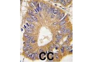 Formalin-fixed and paraffin-embedded human colon carcinoma tissue reacted with EIF4EBP1 Antibody (T69) (ABIN388707 and ABIN2838802) , which was peroxidase-conjugated to the secondary antibody, followed by DAB staining.