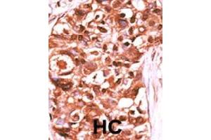 Formalin-fixed and paraffin-embedded human hepatocellular carcinoma tissue reacted with STAT5A (phospho Y694) polyclonal antibody  which was peroxidase-conjugated to the secondary antibody followed by DAB staining.