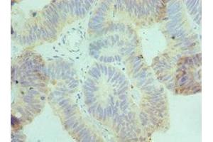 Immunohistochemistry of paraffin-embedded human colon cancer using ABIN7149071 at dilution of 1:100 (AXUD1 antibody  (AA 1-200))
