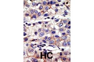 Formalin-fixed and paraffin-embedded human hepatocellular carcinoma tissue reacted with CBX4 polyclonal antibody  , which was peroxidase-conjugated to the secondary antibody, followed by AEC staining.