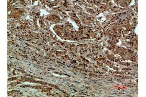 Immunohistochemical analysis of paraffin-embedded human-breast-cancer, antibody was diluted at 1:200 (DCT antibody  (AA 1268-1341))