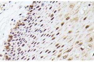 Immunohistochemistry of paraffin-embedded Human esophageal using MLF2 Polyclonal Antibody at dilution of 1:100 (40x lens). (MLF2 antibody)