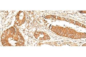 Immunohistochemistry of paraffin-embedded Human colorectal cancer tissue using BAG3 Polyclonal Antibody at dilution of 1:35(x200) (BAG3 antibody)