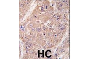 Formalin-fixed and paraffin-embedded human hepatocarcinoma tissue reacted with hUVRAG (Center) (ABIN388587 and ABIN2849985) , which was peroxidase-conjugated to the secondary antibody, followed by DAB staining. (UVRAG antibody  (AA 366-398))