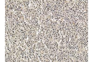 DNA-PK Mouse Monoclonal Antibody at 1/100 staining human gastric cancer by IHC-P.