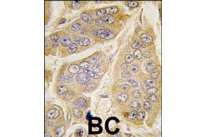 Formalin-fixed and paraffin-embedded human breast carcinoma tissue reacted with NANOS1 polyclonal antibody  , which was peroxidase-conjugated to the secondary antibody, followed by DAB staining. (Nanos Homolog 1 antibody  (C-Term))