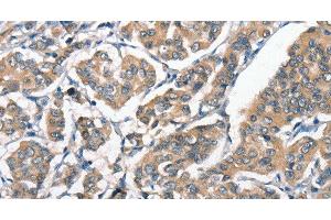Immunohistochemistry of paraffin-embedded Human breast cancer tissue using HGF Polyclonal Antibody at dilution 1:65 (HGF antibody)