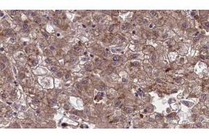 ABIN6273967 at 1/100 staining Human liver cancer tissue by IHC-P. (OR1G1 antibody  (Internal Region))